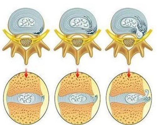 脊柱退變_脊柱退變治療-產(chǎn)品列表頁(yè)-盤(pán)錦骨科醫(yī)院