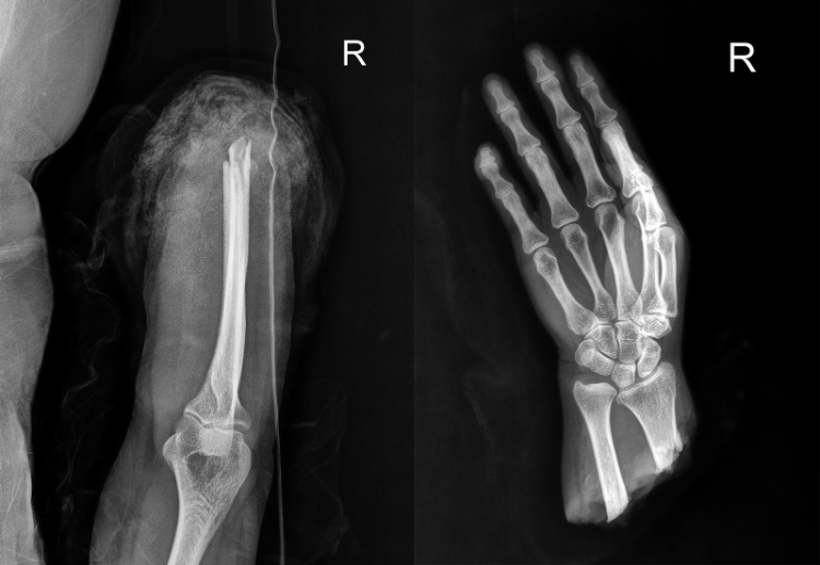 爭分奪秒,斷臂重生重慶長城骨科醫(yī)院完成一例完全離斷肢體再植手術(shù)