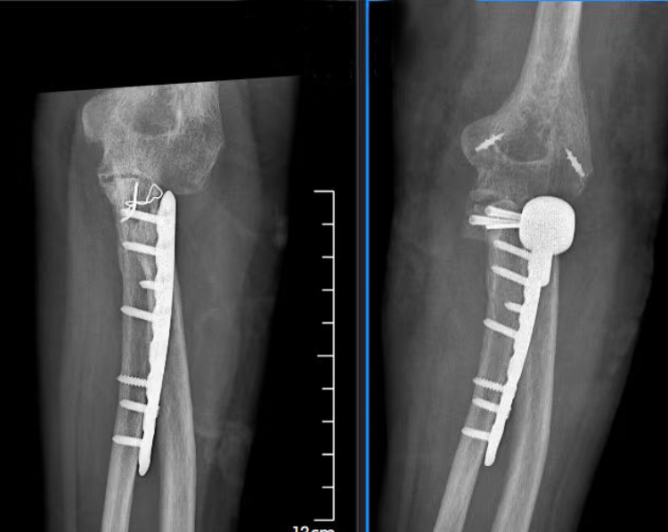 意外摔成肘關(guān)節(jié)“恐怖三聯(lián)征”重慶長城骨科醫(yī)院專家團(tuán)隊妙手解病痛