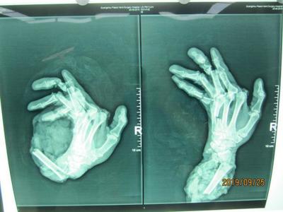 廣州阿伯右手卷入機器“骨肉分離”,醫(yī)生11小時幫他接回手臂